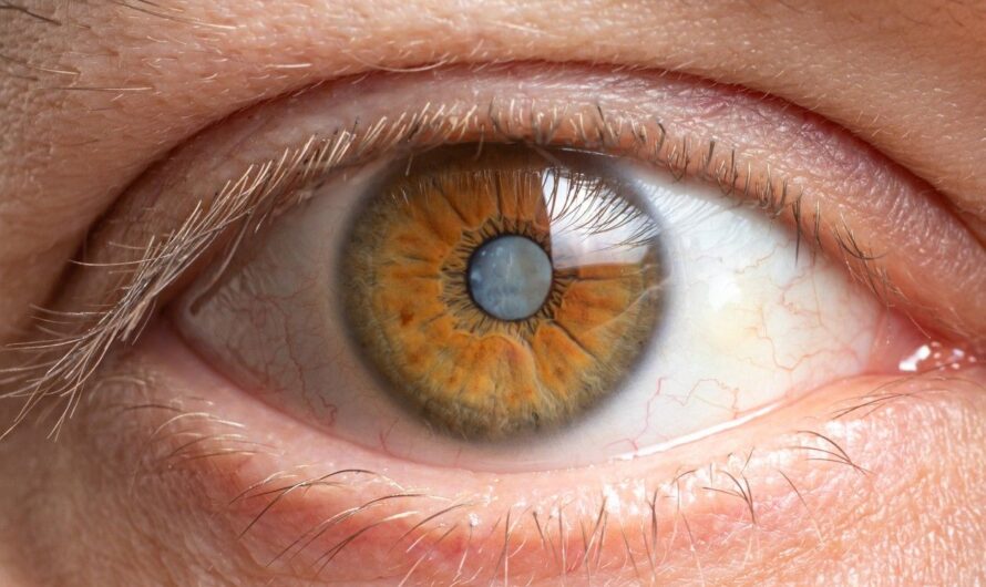 The Shocking Truth About Cataracts: How to Spot the Early Signs and Protect Your Vision