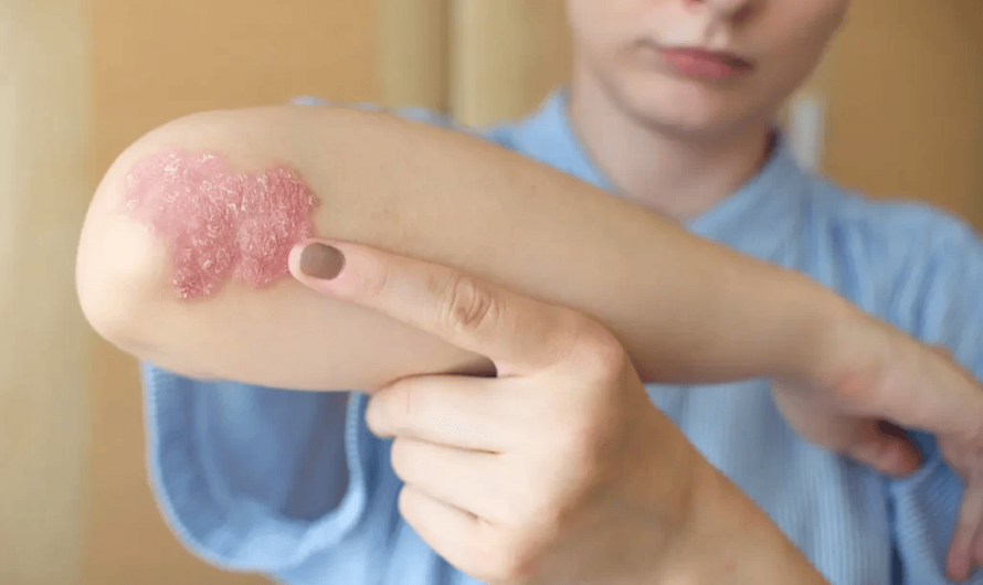 Doctors HATE This! These Home Remedies Could Be the Answer to Your Psoriasis!
