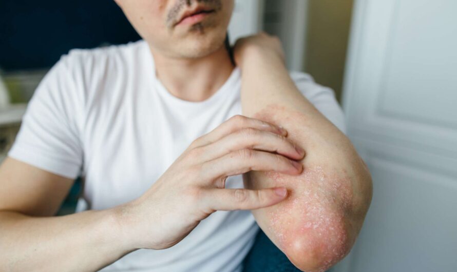 Psoriasis Sufferers, Beware: Recognizing the Early Signs Could Save You Years of Discomfort