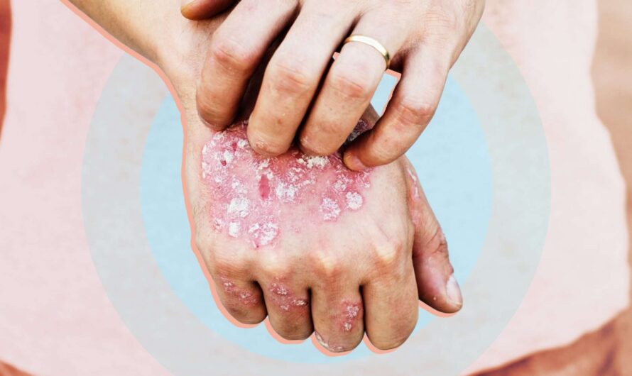 Unconventional Plaque Psoriasis Treatments Options That Are Taking The World By Storm