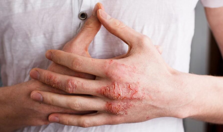 Atopic Dermatitis: Don’t Ignore These Early Signs – Your Skin Deserves the Best Care